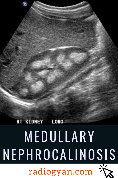 Medullary Nephrocalcinosis | Radiology Case | RadioGyan.com | Imagenologia