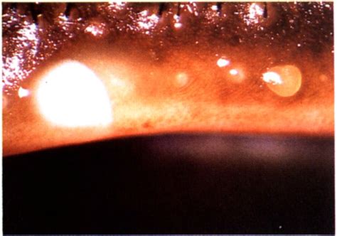 g. A dome of very cloudy liquid secretion expressed at the mouth of... | Download Scientific Diagram