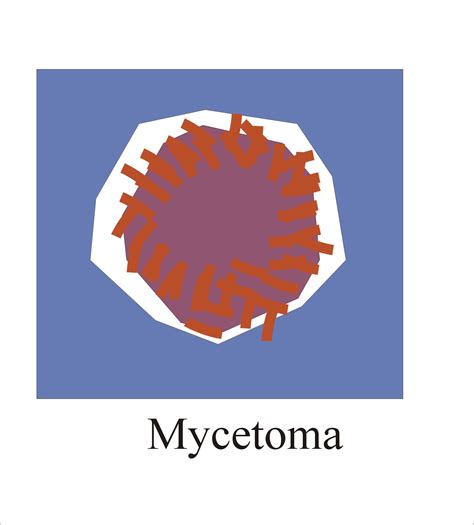 Mycetoma Diagnosis and Causative Agents - Labpedia.net