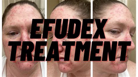 Showing You Every Day of My Efudex Treatment ~ Topical Chemotherapy Cream ~ - YouTube