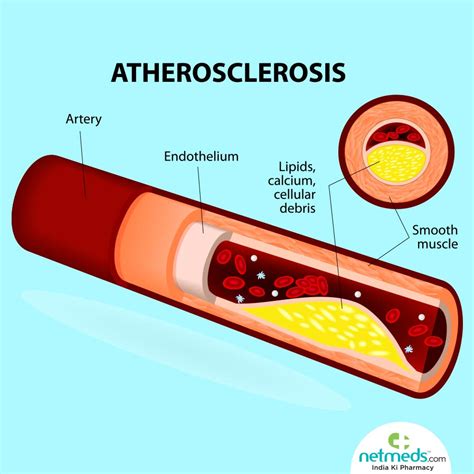 Abdominopelvic Atherosclerosis