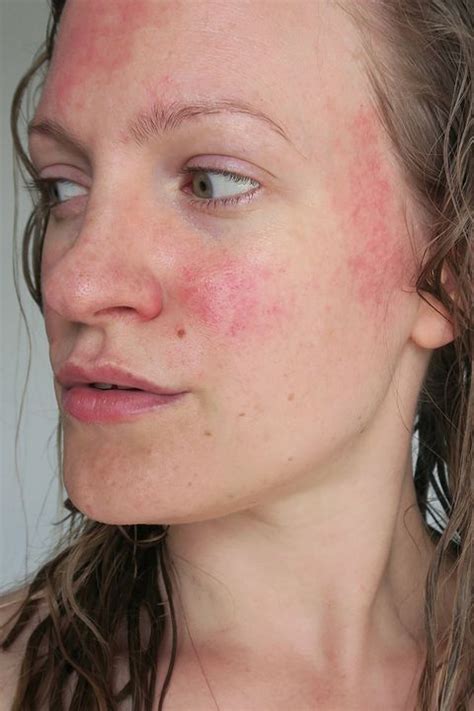 All you need to know about red spots or redness on the skin