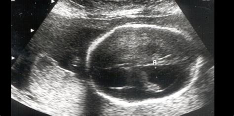 ARDMS Gynecology Review Questions: Quiz 126 - StudyPK