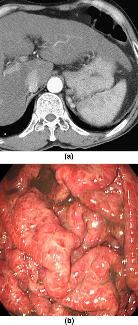 Dynamic CT of portal hypertensive gastropathy: significance of transient gastric perfusion ...