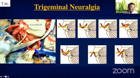 Microvascular Decompression Surgery – Surgical Anatomy and Procedures- Toshio Matsushima - YouTube