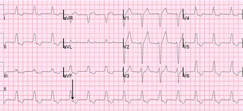 Junctional Rhythm – ALS Training