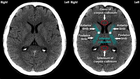 Ujjwal Upadhyay - Brain Anatomy using CT Scans