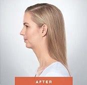 Chin Fat Removal with Kybella | Plastic Surgeon Dr. Lorelle Kramer, MD