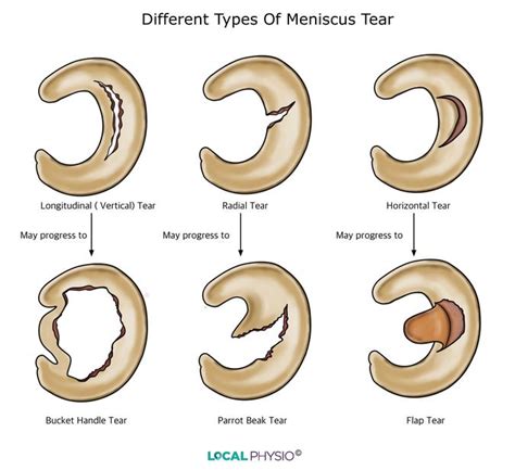 Meniscus Tear | Local Physio