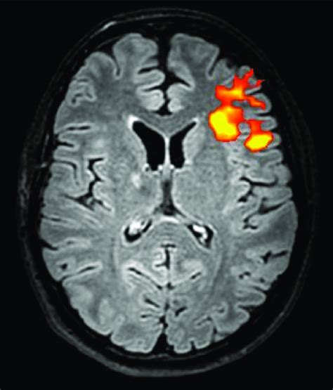 Speech fMRI of an epileptic patient showing cortical activation in ...