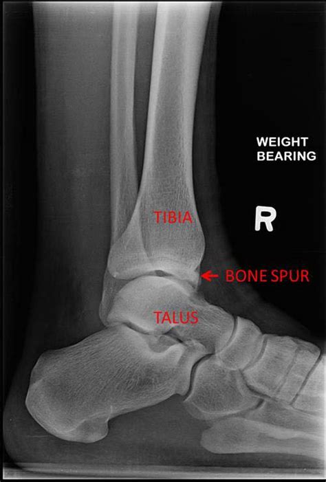 What is an ankle cheilectomy? - Orthopedic Specialists of Seattle