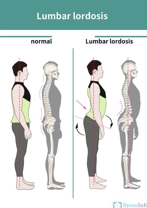 Lordosis: Definition, Causes, Symptoms, Diagnosis, and Treatment - Spine Info