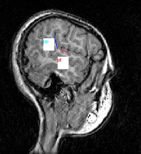 Figure 2 from Planum temporale and planum parietale morphology in children with developmental ...