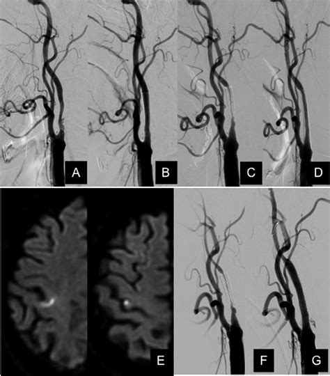 Case 3. A : Preoperative angiogram showing severe carotid stenosis. B :... | Download Scientific ...