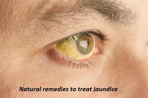 9 Known and favorable natural remedies to treat jaundice