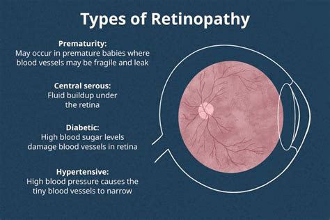 Types of Retinopathy