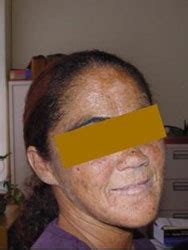 Variegate Porphyria | Porphyria for Professionals