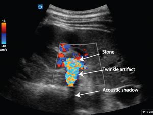 Renal colic - the twinkle artifact - Critical Care Sonography