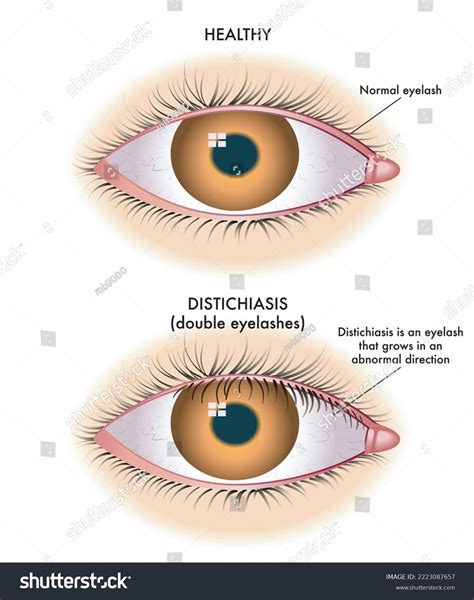 1 imágenes de Congenital distichiasis - Imágenes, fotos y vectores de ...