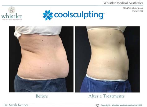 Does Coolsculpting Help With Excess Skin