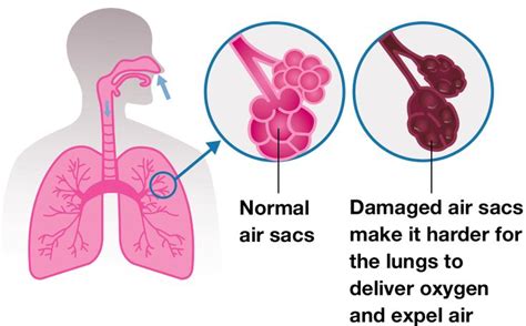 What is COPD? (Chronic Obstructive Pulmonary Disease) | COPD.com | Chronic obstructive pulmonary ...