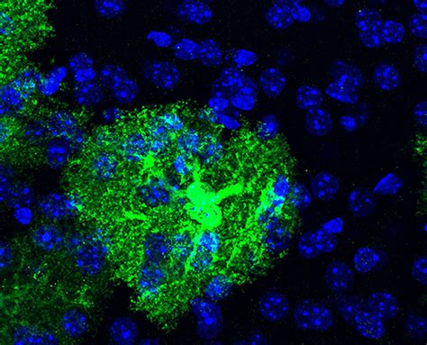 Silencing a killer: Mutant HTT gene selincing as a therapy for ...