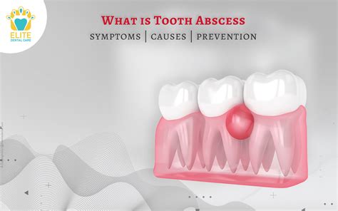 What are tooth abscess symptoms, causes, and prevention? | Elite Dental ...