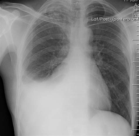 Pleural effusion chest x ray - wikidoc