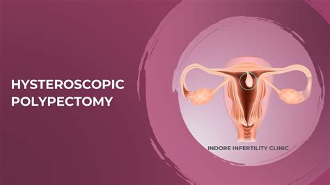 Removal of Uterine Polyp | Hysteroscopic Polypectomy (How is it done) | Removal of Polyp in ...