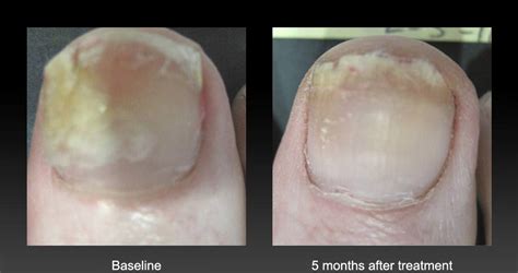 Laser is new tool in targeting toenail fungus “Now Available in Sudbury”