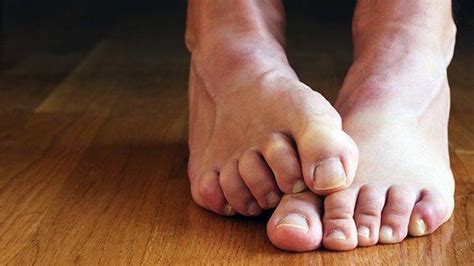 5 Nonsurgical Ways To Alleviate Bunion Pain: Arlington/Mansfield Foot ...