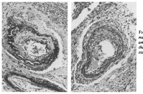 Figure 1 from Lipohyalinosis and Miliary Microaneurysms Causing Cerebral Hemorrhage in a Patient ...