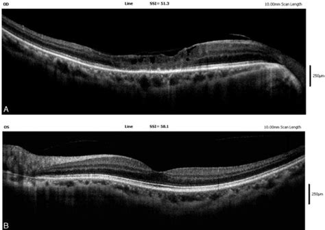 A) SD-OCT showed atrophy of central macular with diminished IS/OS ...