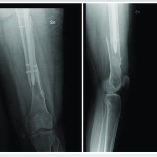 Postoperative radiographs of the left femur periprosthetic fracture ...