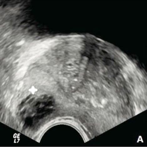 (PDF) A new ultrasound and clinical classification for management of prostatic abscess