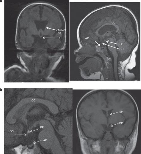 ON - RADIOLOGY: MRI on Absence of the Septum Pellucidum?