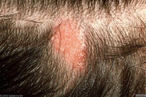 nevus sebaceus of jadassohn - pictures, photos