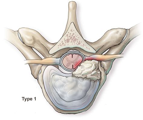 Herniated Disc Thoracic Mri