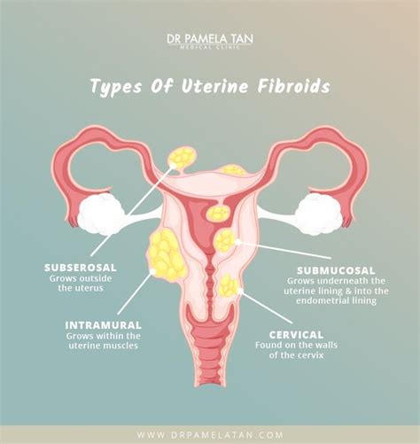 Pin on Obstetrics / Gynecology Infographics