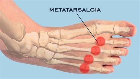 Forefoot Disorders: Metatarsalgia