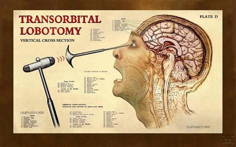 Ice- Pick Lobotomy and A Hole in the Head - HubPages