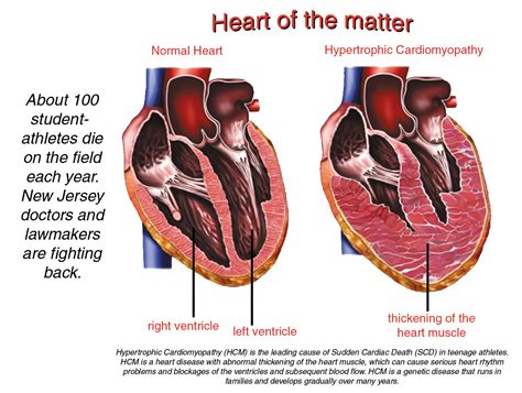 New Jersey begins to tackle sudden cardiac death in scholastic athletes ...