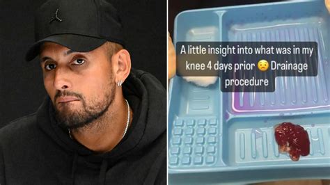 Nick Kyrgios posts gruesome drained knee photo as cyst in meniscus forces ‘heartbroken’ star out ...