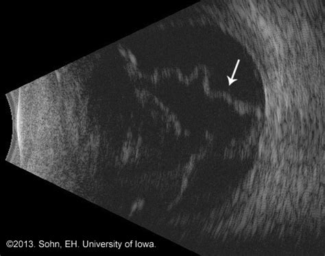 Retinal Detachment Ultrasound