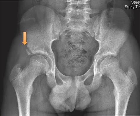 Anteroposterior radiograph of a right hip anterior inferior iliac spine... | Download Scientific ...