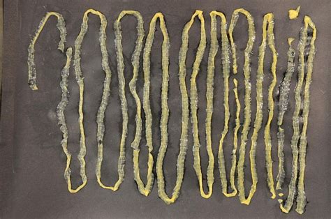 2.8m-long tapeworm found in patient who had no symptoms | Inquirer News