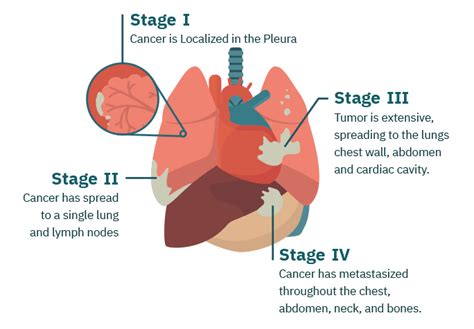 Mesothelioma Stages | Asbestos Cancer Staging & Classification