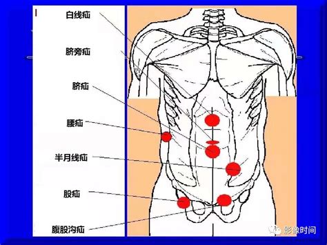 右侧阴疝女性,小女孩腹股沟疝气图片 - 伤感说说吧