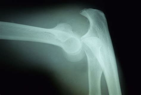 Elbow Dislocation Causes, Symptoms, and Treatment