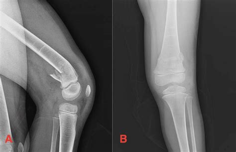 Distal Femur Fracture Classification